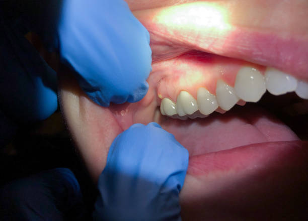 Best Same-Day Emergency Dentist in Wolcottville, IN