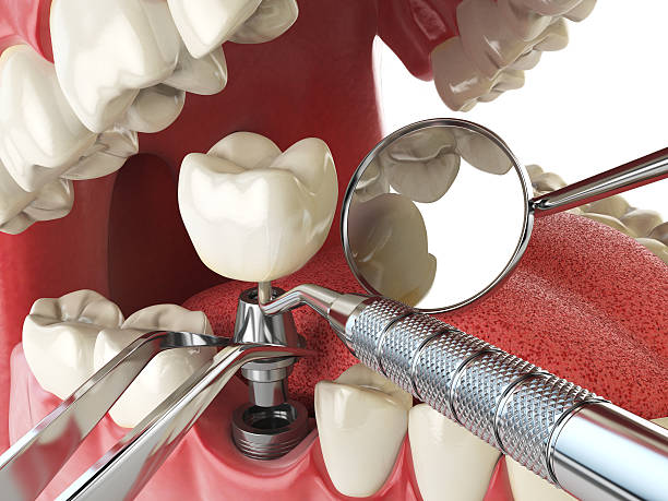 Best Emergency Dental Surgery in Wolcottville, IN